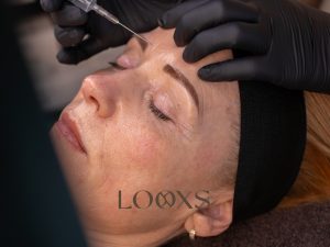 Botox en fillers behandeling bij Looxs The Skin Studio in Echt, Limburg