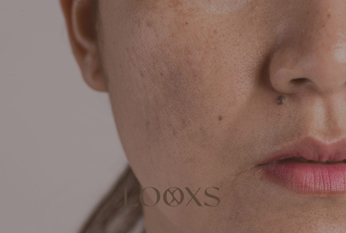 Pigmentvlekken op de wang – Looxs The Skin Studio in Echt (Limburg)