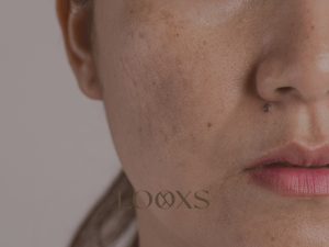 Pigmentvlekken op de wang – Looxs The Skin Studio in Echt (Limburg)