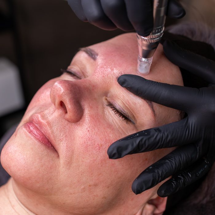 Micro needling Looxs